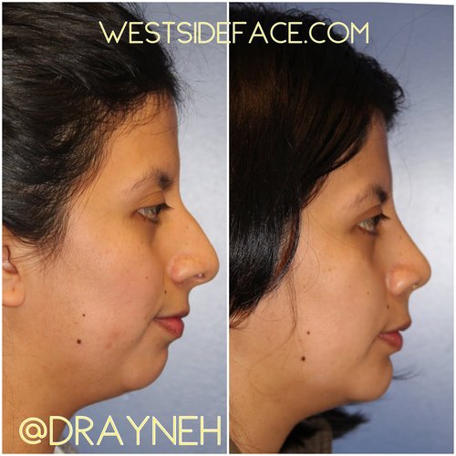 Los Angeles Rhinoplasty Surgeon