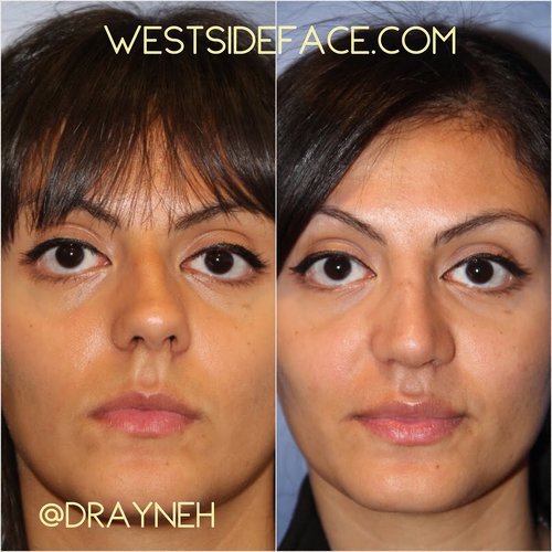 Los Angeles Rhinoplasty Surgeon