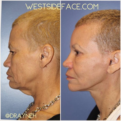 Los Angeles Facelift