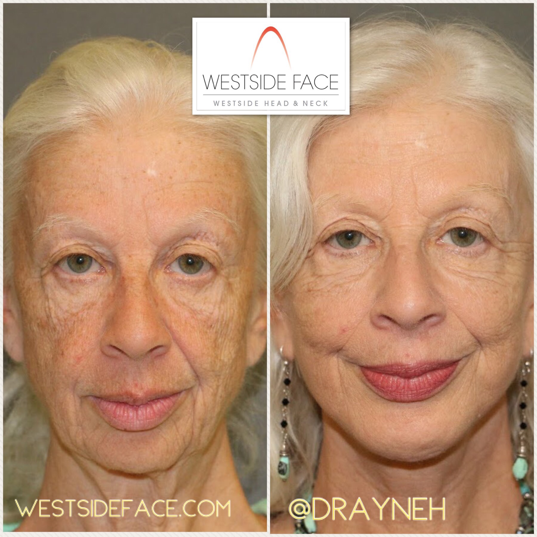 Westside Face Santa Monica Plastic Surgery Cosmetic Surgery
