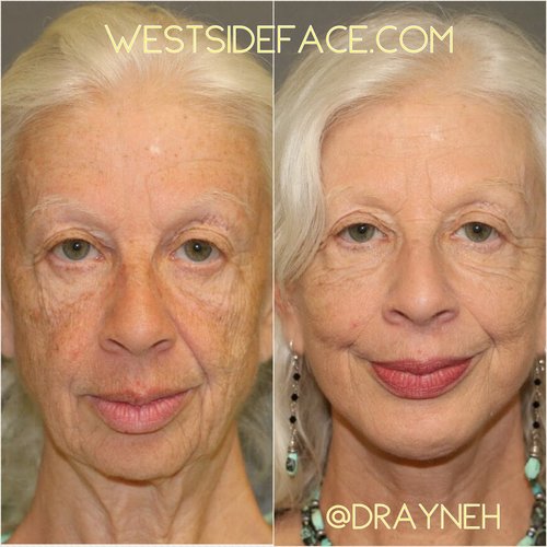 Female Facelift, necklift, and chin implant
