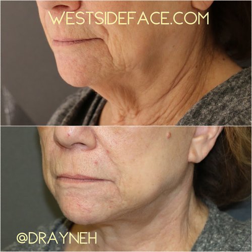 Female Necklift(1)
