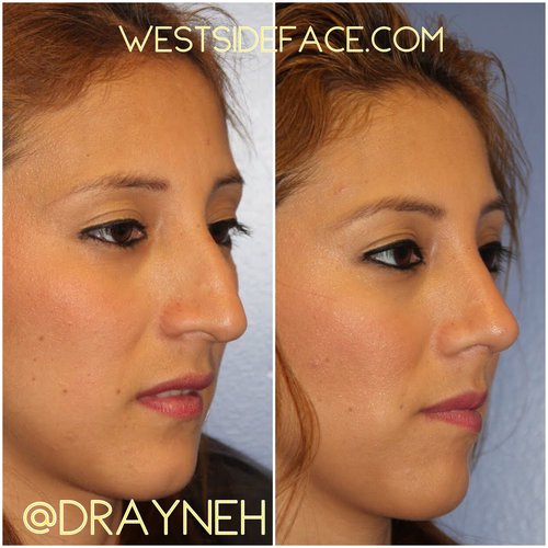 Female rhinoplasty (13)