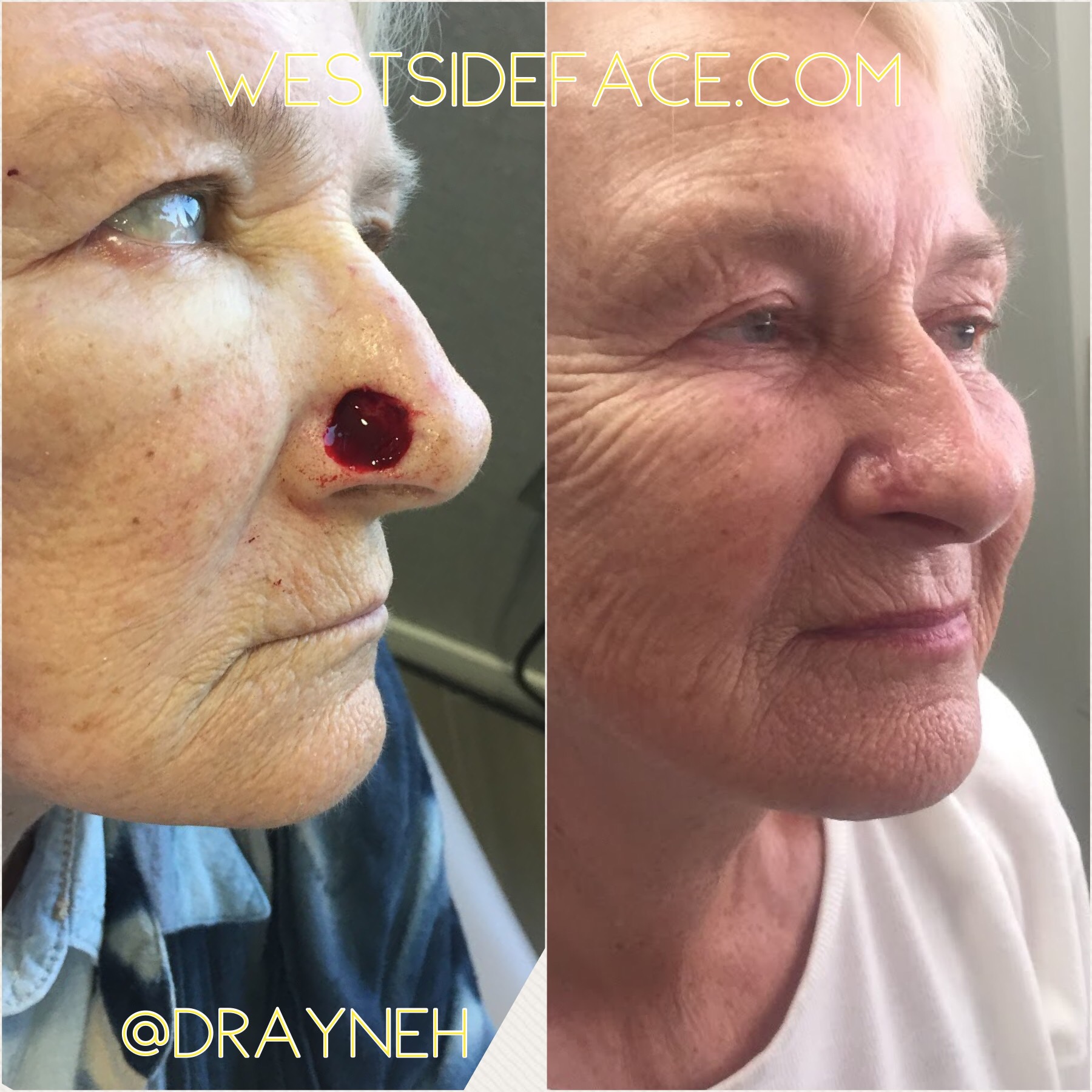 Nose Repair MOHS Westside Face