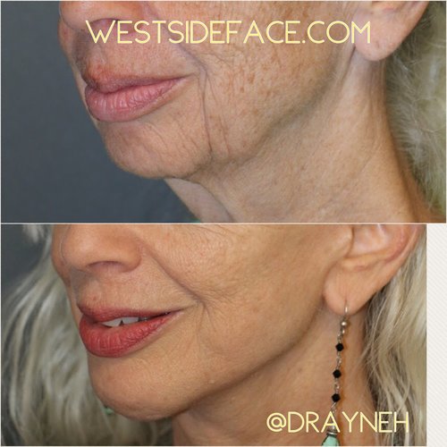 Facelift, necklift and chin implant