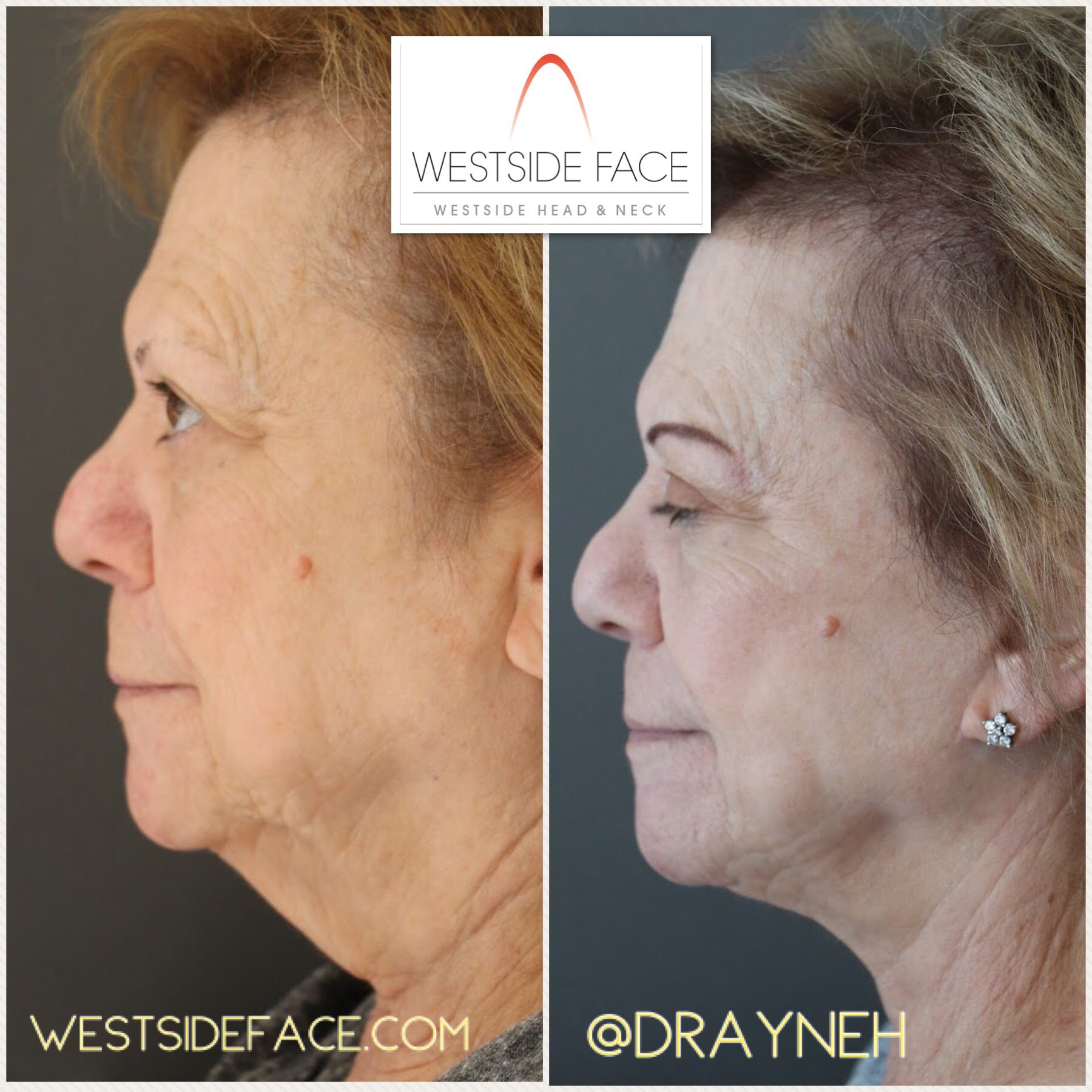 Female Necklift