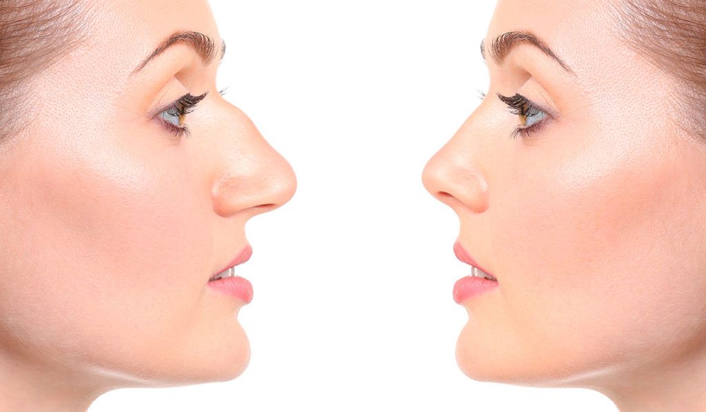 Cleft Nasal Deformity and Rhinoplasty