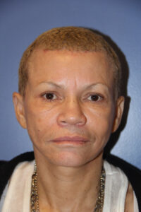 Bleph brow lift