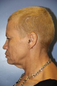 Bleph brow lift