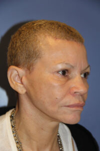 Bleph brow lift