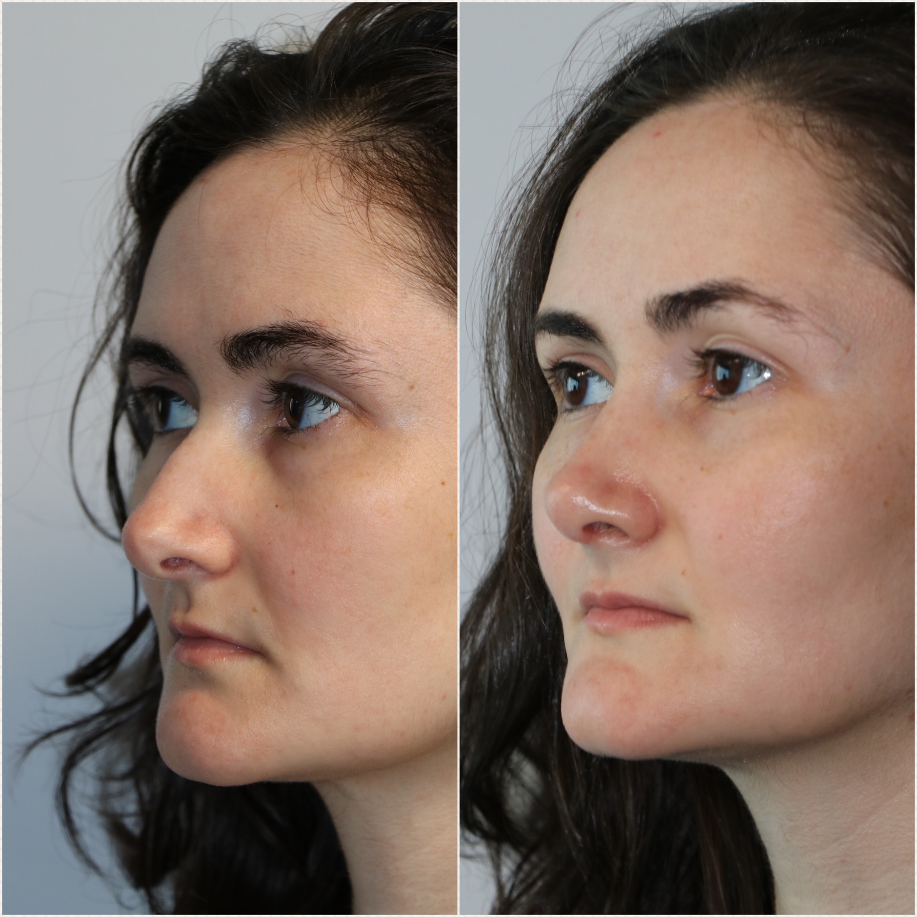 Crooked Nose Repair Westside Face