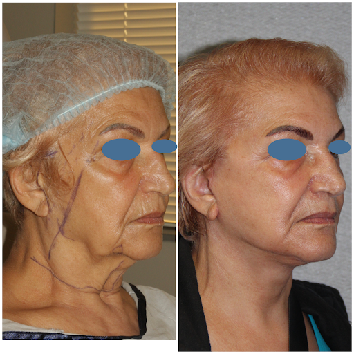 Facelift Risks &#038; Safety