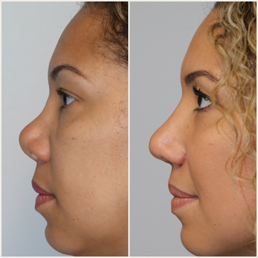 Rhinoplasty for Saddle Nose