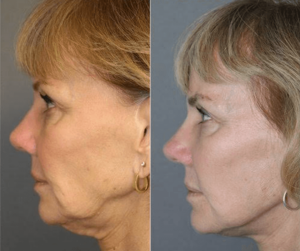 Facial Plastic Surgeon in Los Angeles