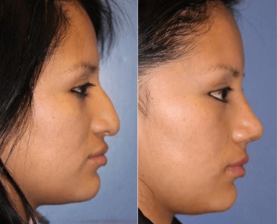 Facial Plastic Surgeon in Los Angeles